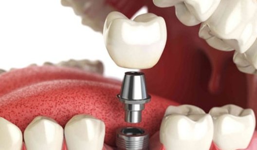 Имплантация зубов, ее преимущества и процесс