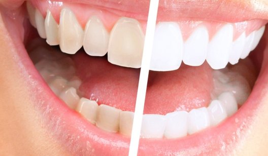 Отбеливание зубов: преимущества и показания к процедуре